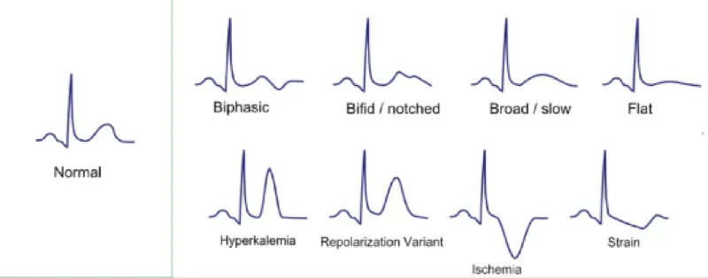 ECG classification
